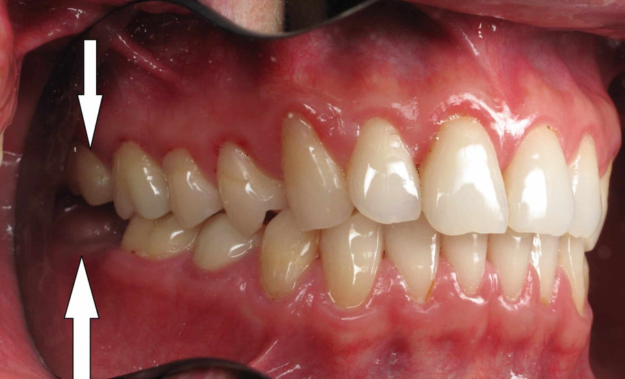 La perte des dents postérieures affecte-t-elle la déglutition ?
