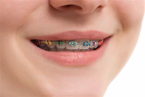 Un dentiste peut-il enlever la plaque avec un appareil dentaire ?