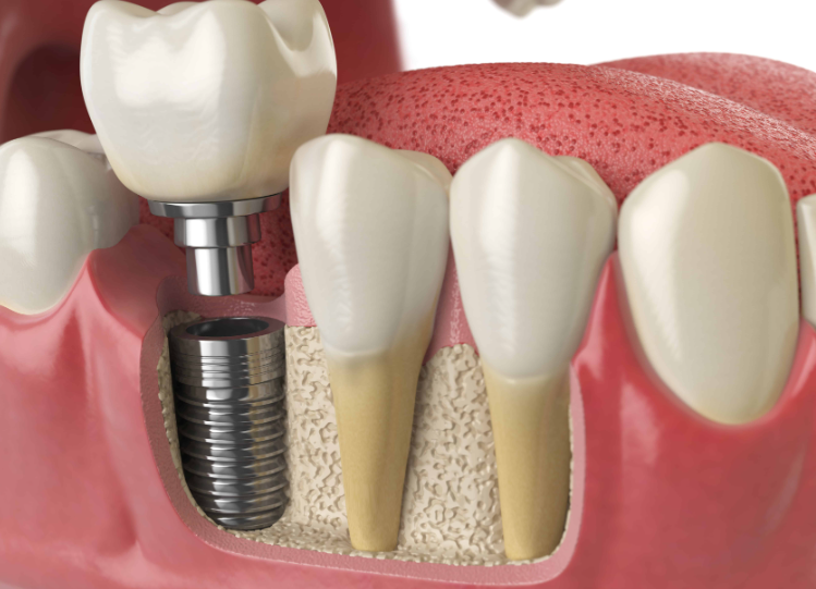 Combien coûtent les implants dentaires ?