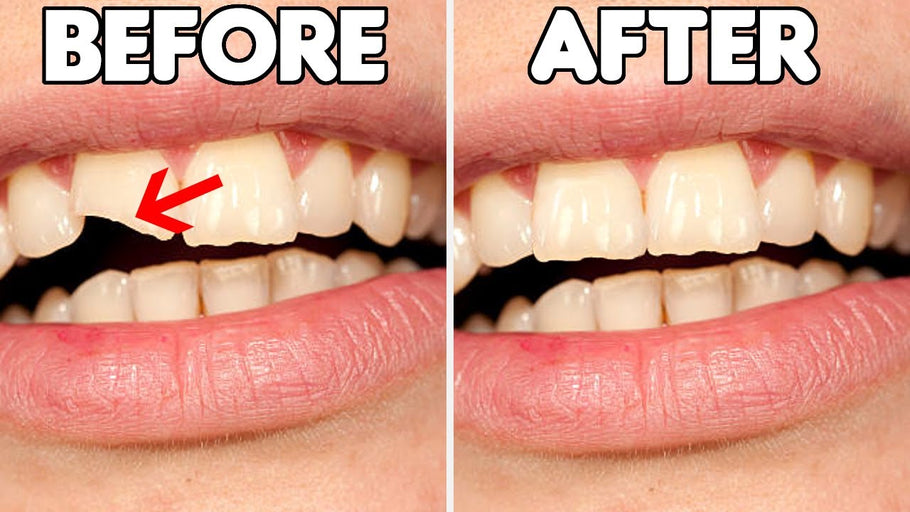 Comment réparer une dent ébréchée ?