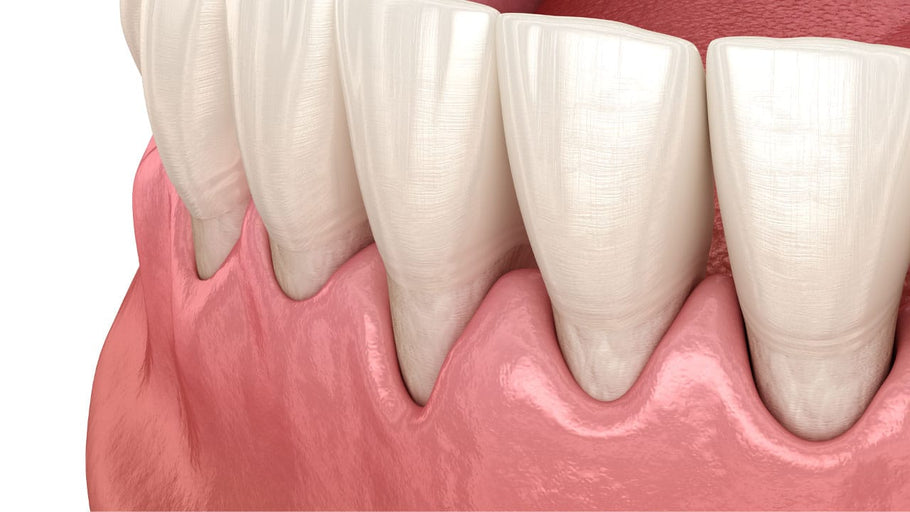 Les brosses à dents soniques sont-elles bonnes pour les gencives rétractées ?