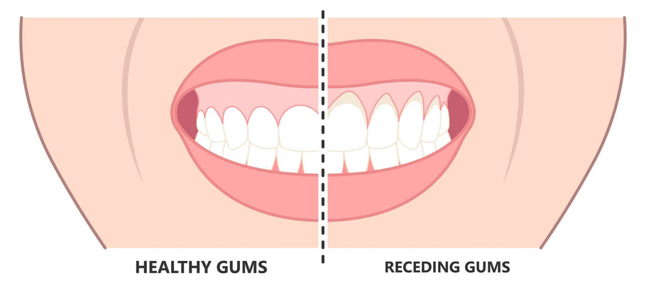 Comment le déchaussement des gencives peut-il progresser avant que les dents ne tombent ?