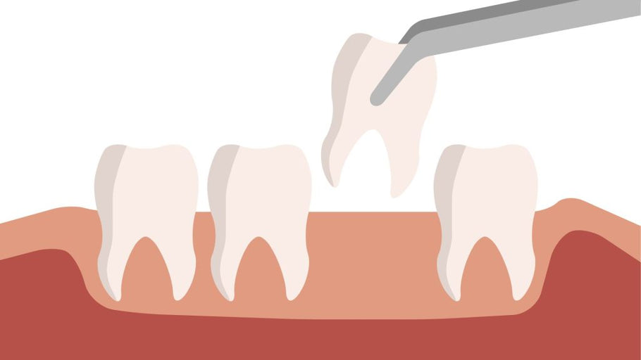 Combien de temps après une extraction dentaire puis-je manger ? Un guide complet