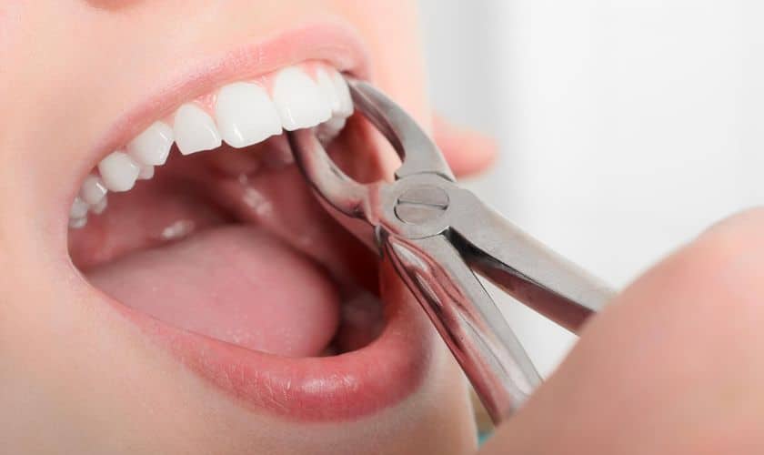Combien de temps prend la guérison d'une extraction dentaire ?