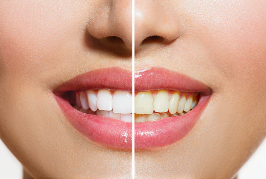 Pourquoi mes dents sont-elles jaunes alors que je les brosse tous les jours ?