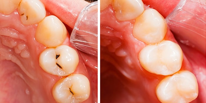 Combien de temps après un plombage puis-je me brosser les dents ?