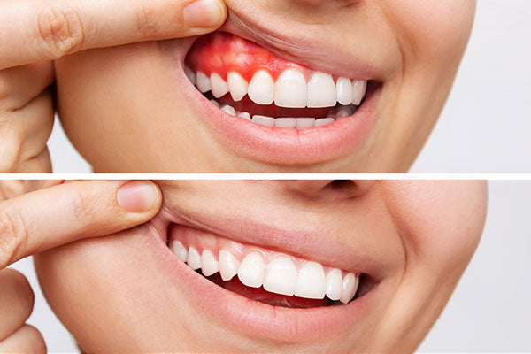 Comment soigner la maladie des gencives sans dentiste : remèdes efficaces à domicile et conseils de prévention
