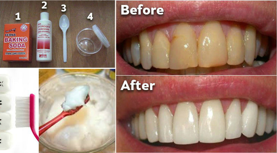 Comment enlever le tartre des dents sans dentiste