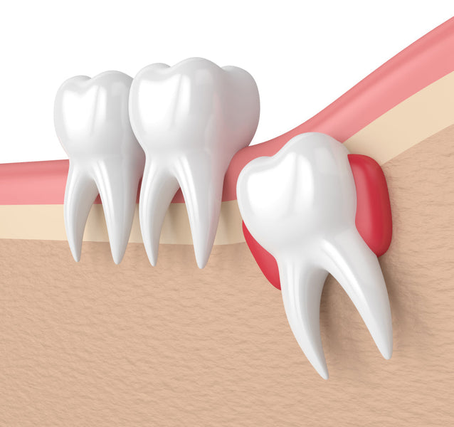 Quand poussent les dents de sagesse ?
