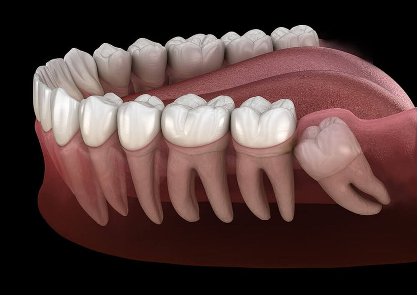 Les dents de sagesse peuvent-elles repousser ? Mythes, faits et aperçus dentaires